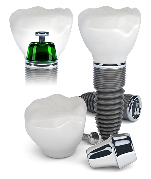 Osborn Mills Dental Implants